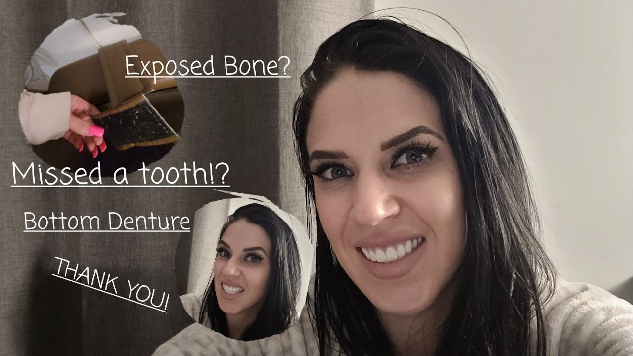 Denture Diary Updates Day 14-26