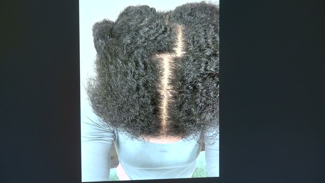 1-Year African American Hair Transplant Result | Natural Zigzag Hairline Restoration – Dr. John Diep