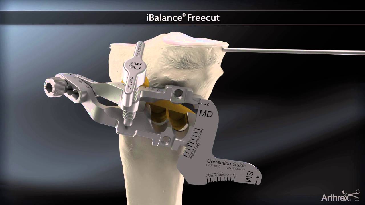 Chirurgie de l'Arthrose Osteotomie tibiale de valgisation Dr Philippe Loriaut