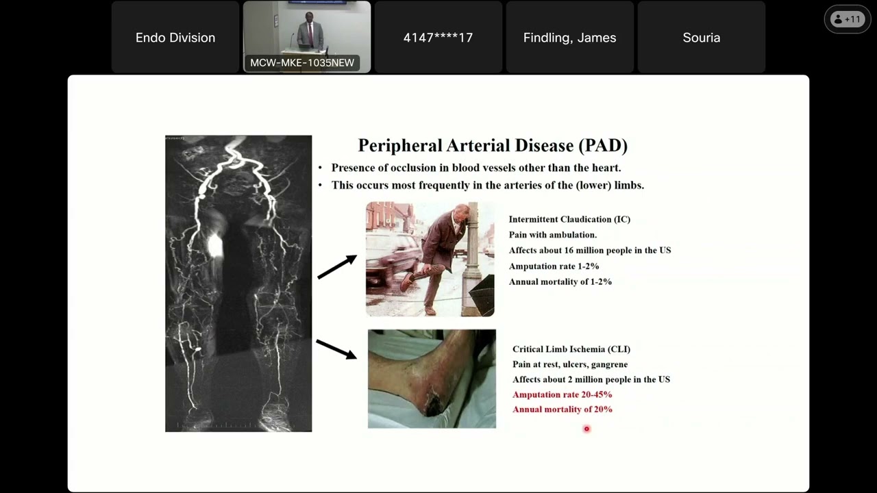 Exploration of Mechanisms Contributing to Poor Disease Outcomes in Diabetic Peripheral Artery Dis.