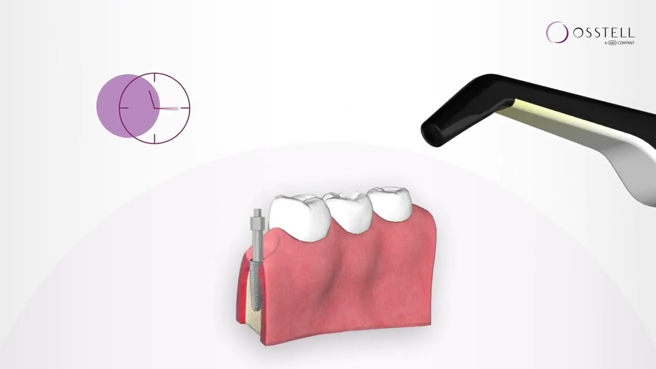 Why measure implant stability?