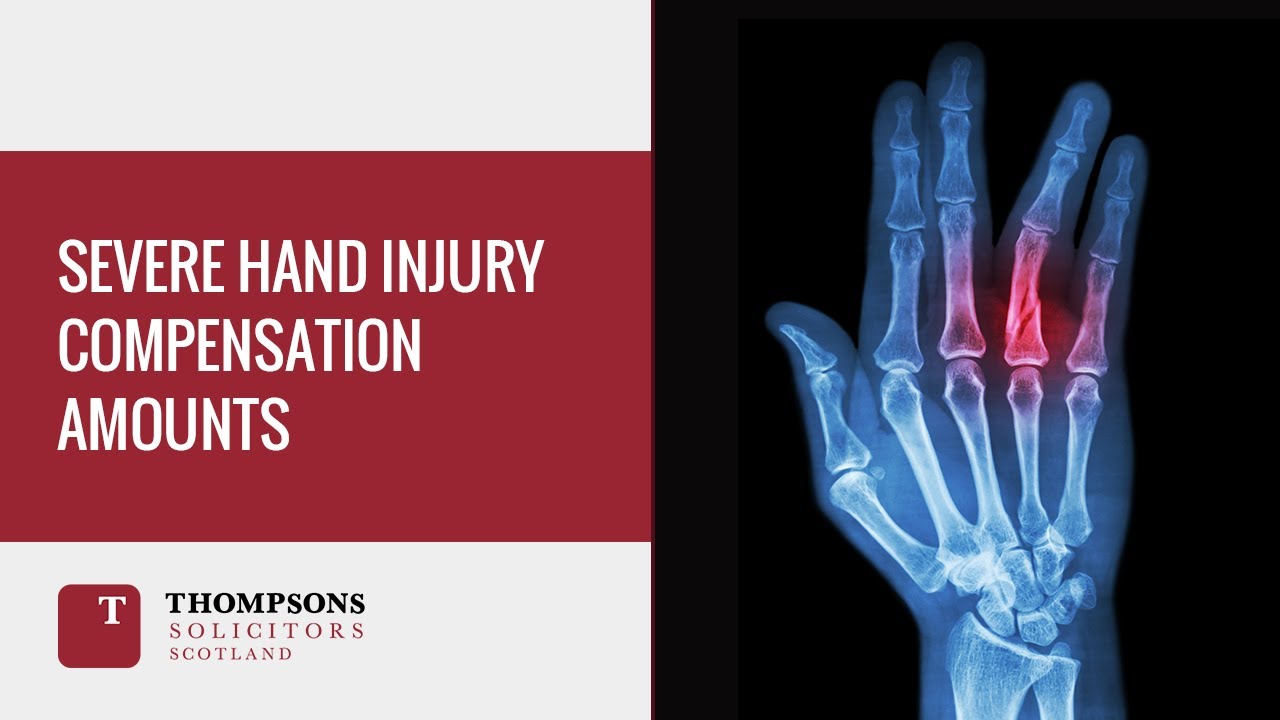 Severe Hand Injury Compensation Amounts