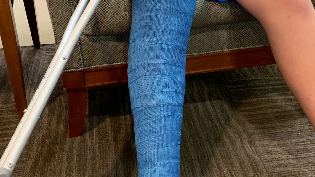 Triplane fracture..Fiberglass cast for three weeks