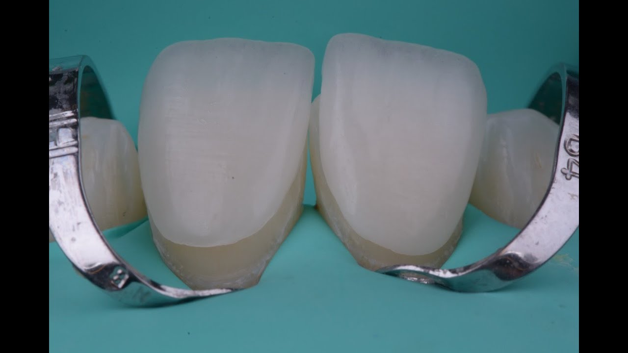 Isolamento absoluto e cimentação  lentes de contato cerâmicas (Facetas).