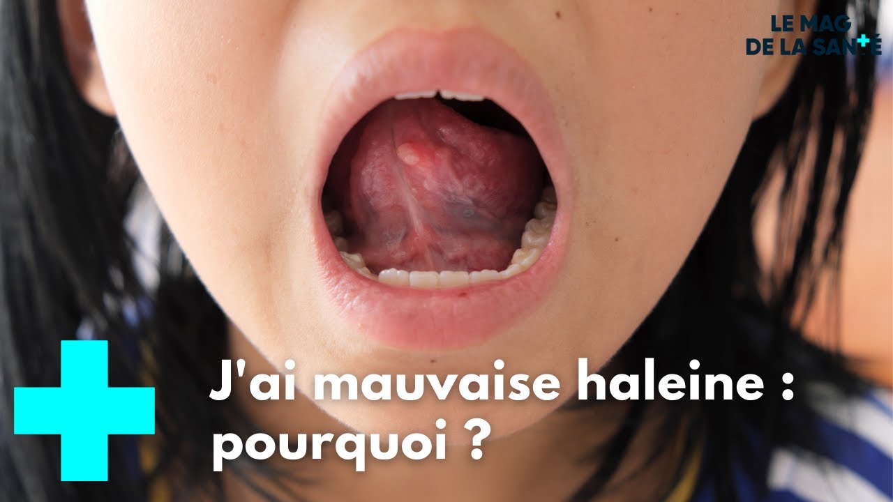 J'ai mauvaise haleine : pourquoi ? - Le Magazine de la Santé