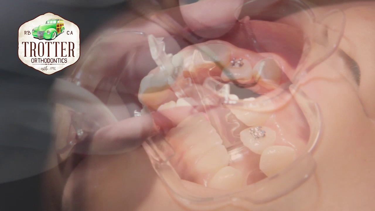 Watch How Braces Are Put On - Orthodontic Treatment Using Fixed Brackets  Redondo Beach Orthodontist