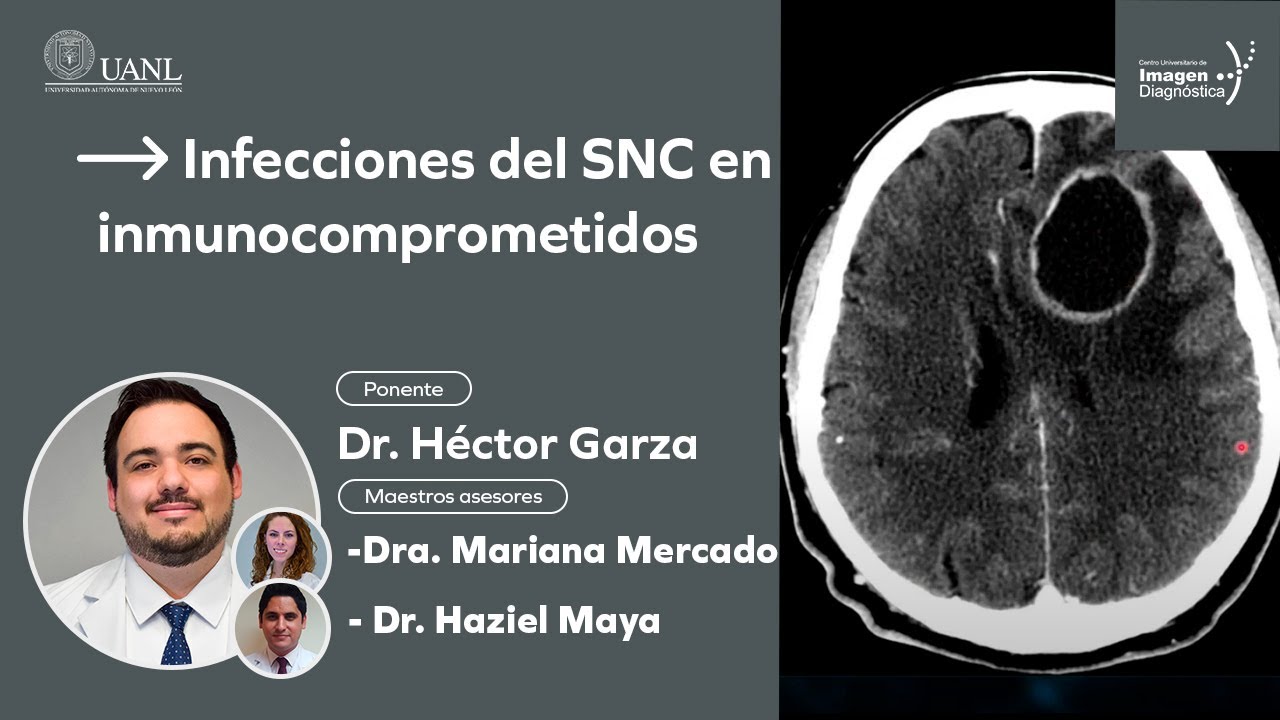 Infecciones del SNC en inmunocomprometidos por el Dr. Héctor Garza.