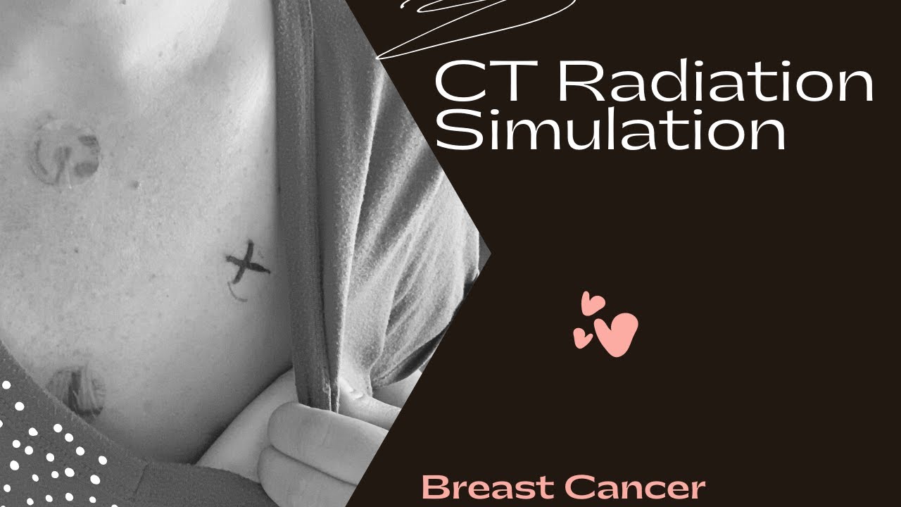 CT Simulation for Radiation Therapy