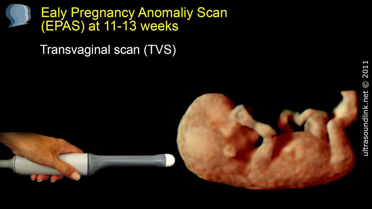 The 12 week scan: transabdominal and transvaginal ultrasound
