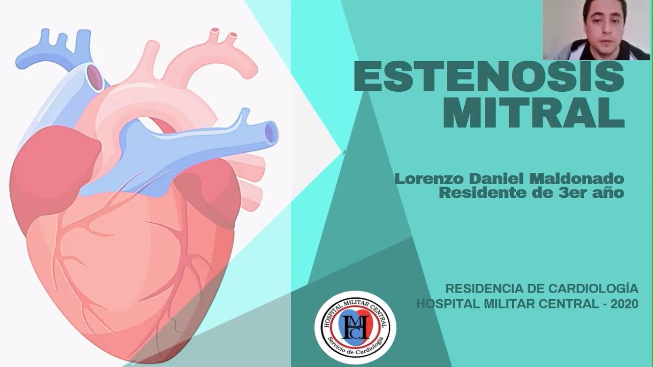 Estenosis mitral   Módulo de valvulopatías