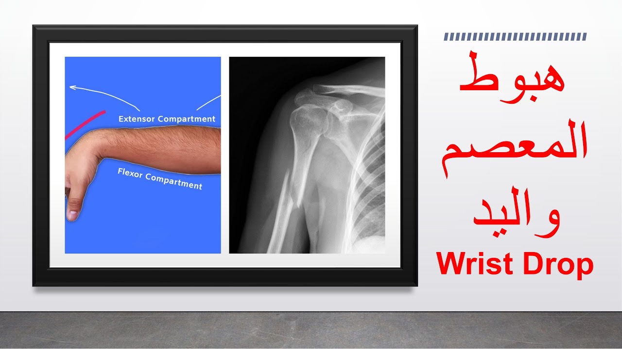 Wrist Drop /  هبوط المعصم و عدم القدرة على بسط اليد و الأصابع