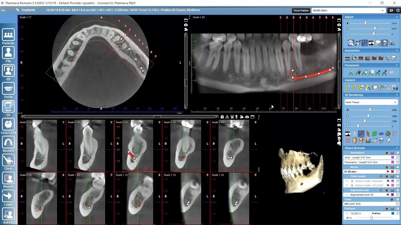 Working with cross-sections in Planmeca Romexis 3D module