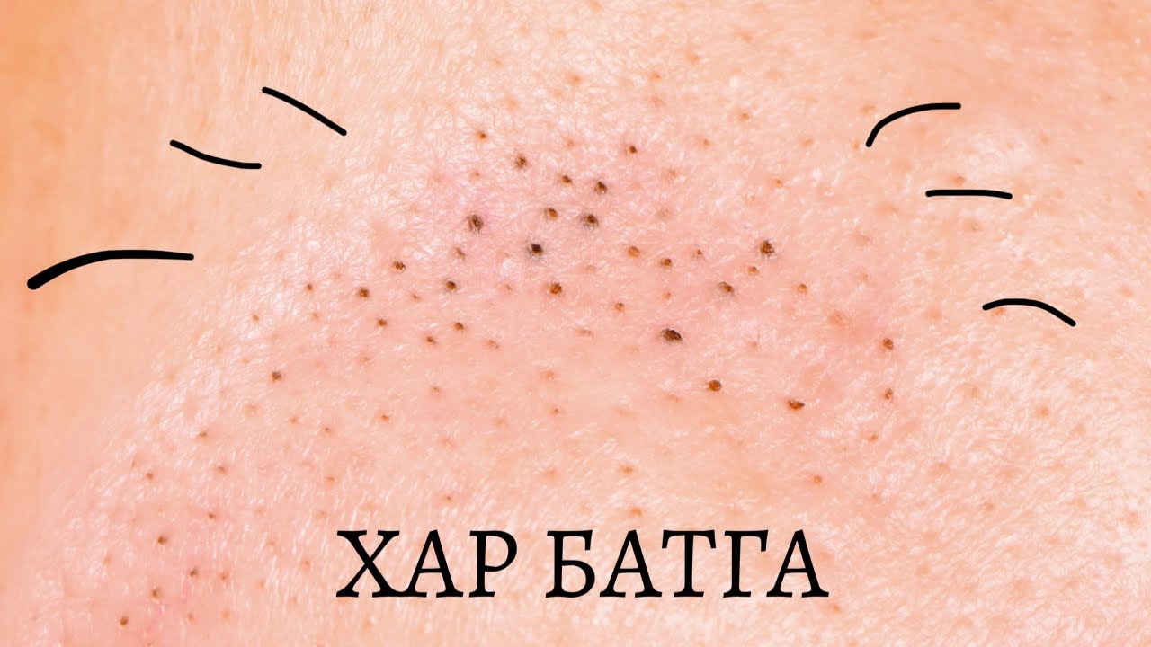 Хар батга хайлуулах “SKIN GRITTING METHOD”