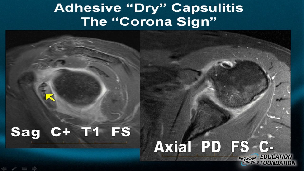 Shoulder Instability on MRI: Part III The golden rule of Dynamic Labral Interpretation