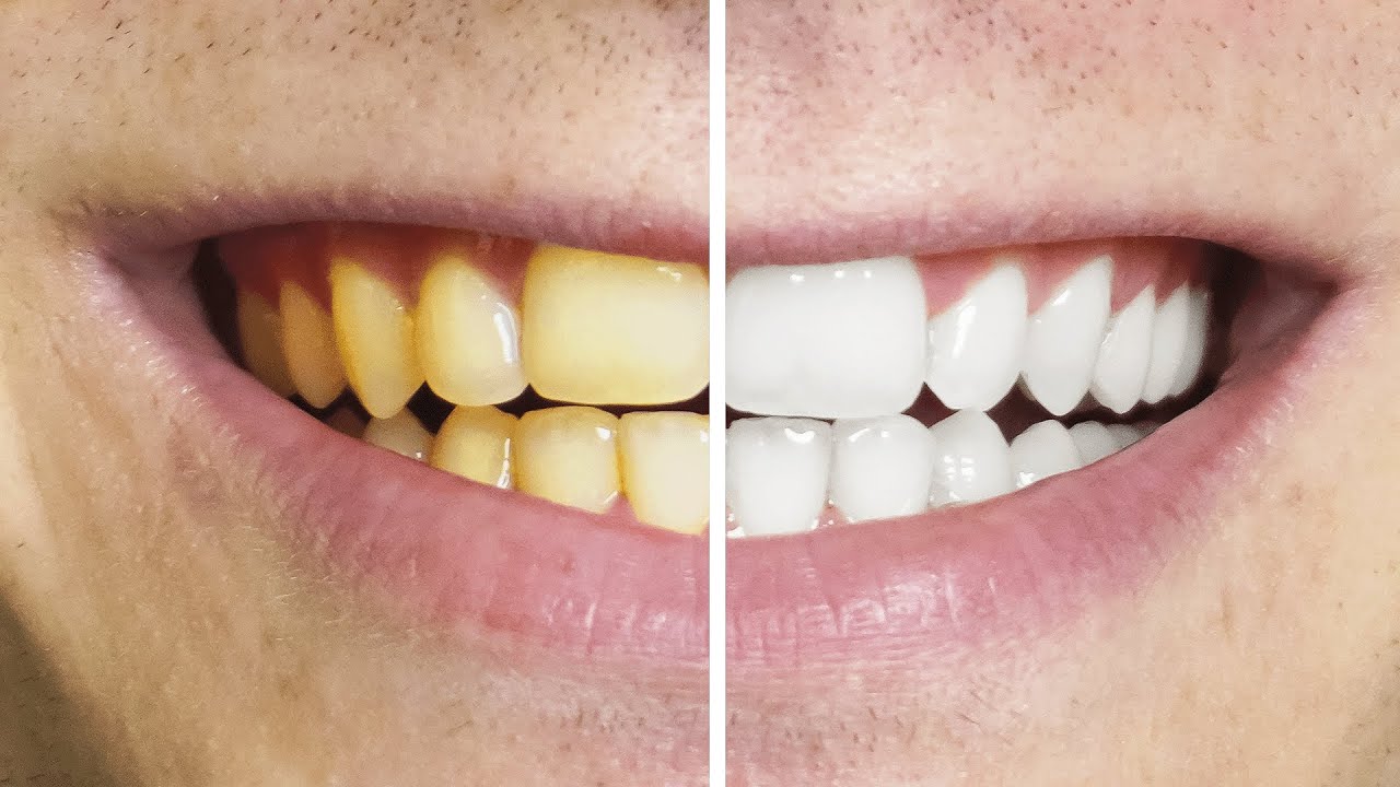 C&oacute;mo quitarte los dientes amarillos naturalmente HAZ ESTO