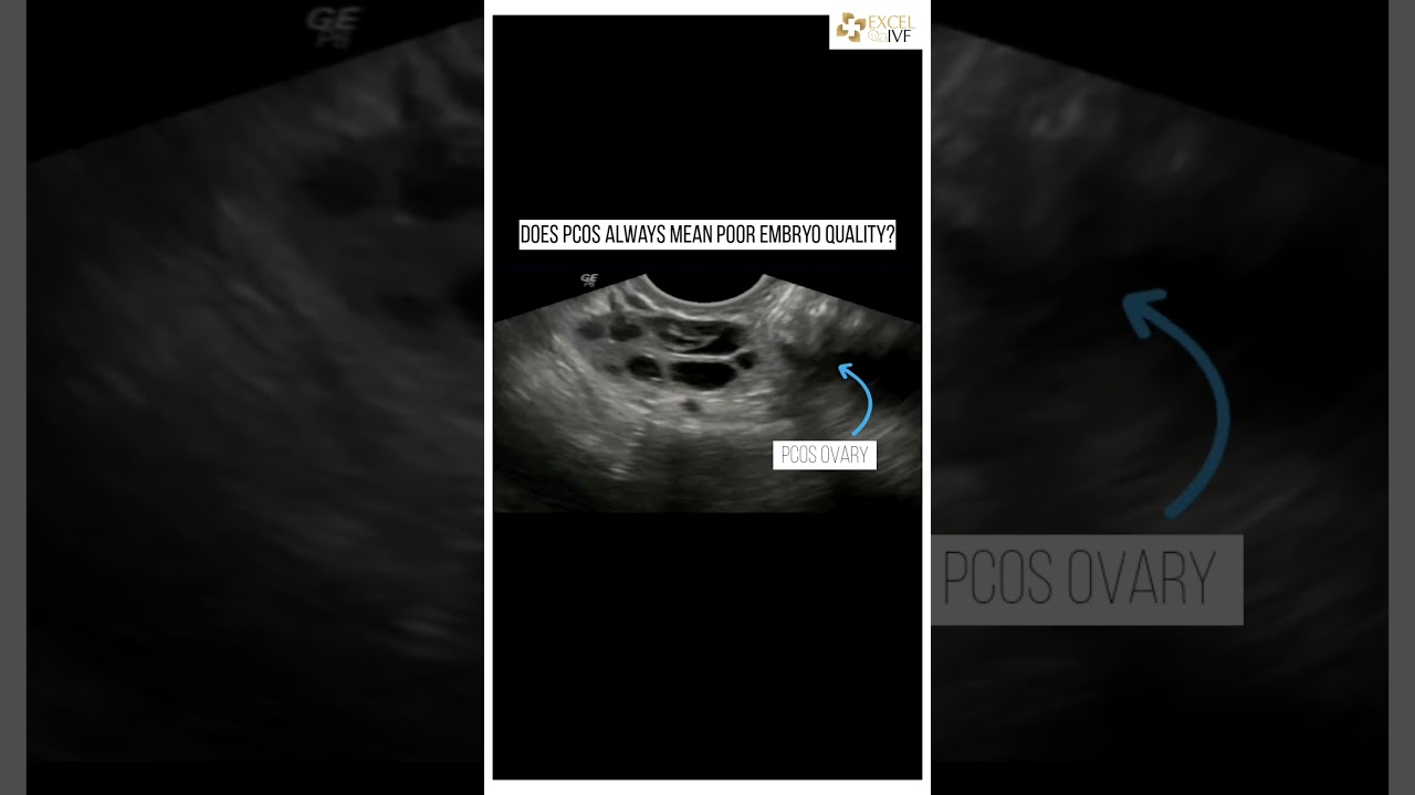 PCOS &ne; Poor Embryos | Dr Rhythm Gupta - Infertility and IVF specialist at Excel IVF