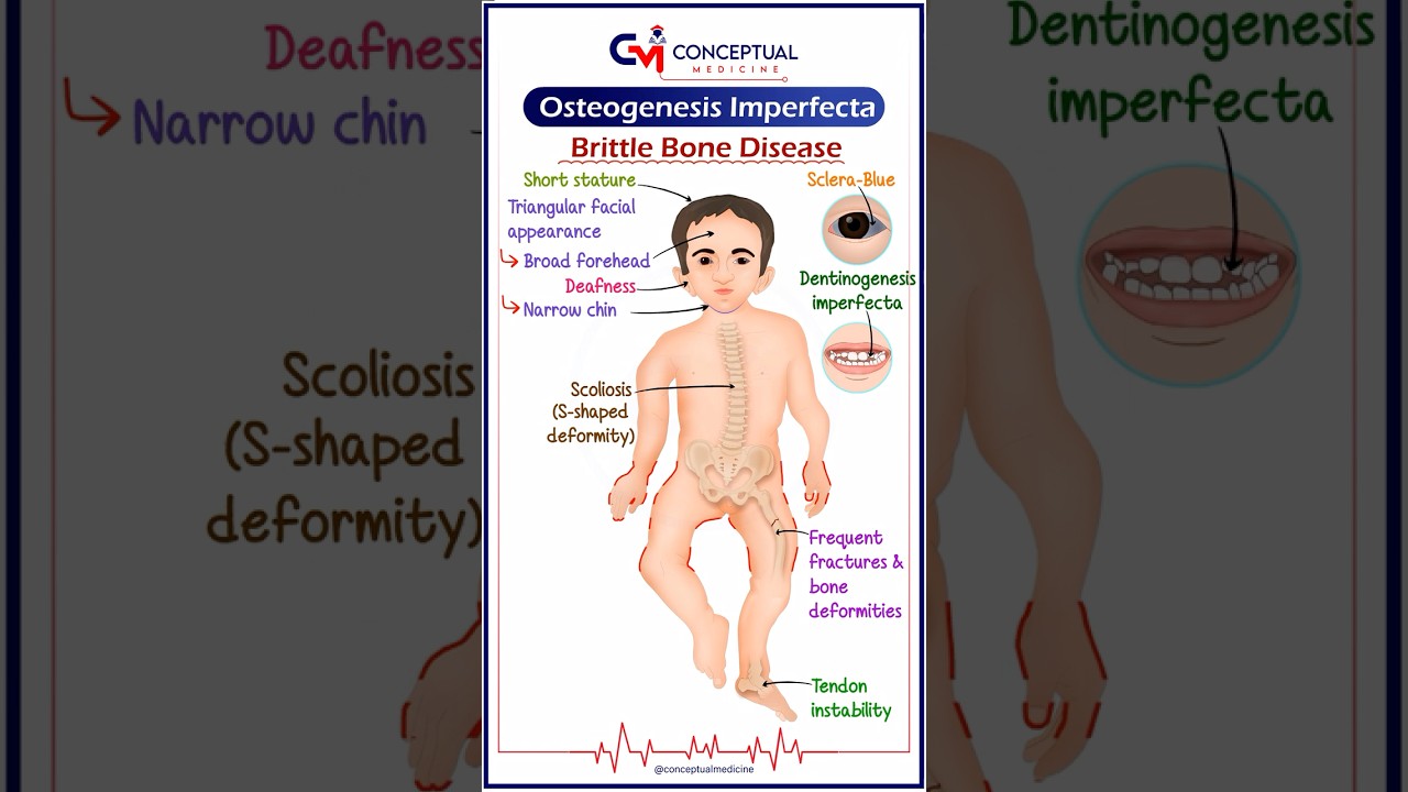 Несовершенный остеогенез 🦴 | Синяя склера 👁️ | Хрупкость костей 🚨
