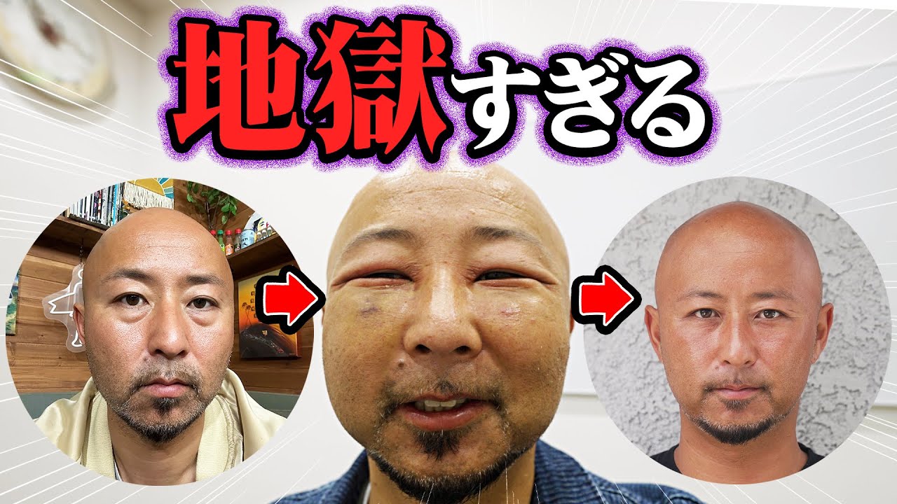 【衝撃】40代男性が挑戦した目の下のクマ取り整形！ダウンタイムが想像以上に過酷だった…