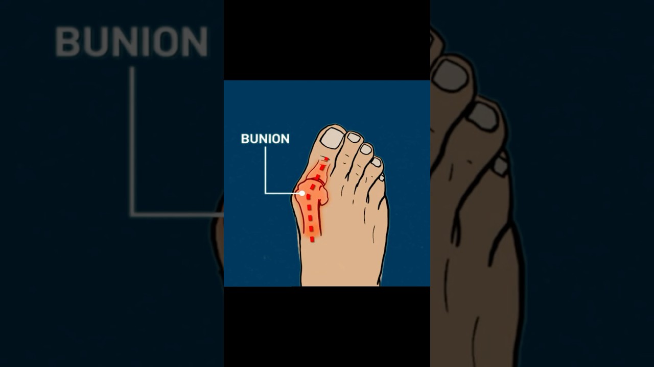 What Is Hallux Valgus (Bunion)? Explained Fast! #anatomy #physiotherapy