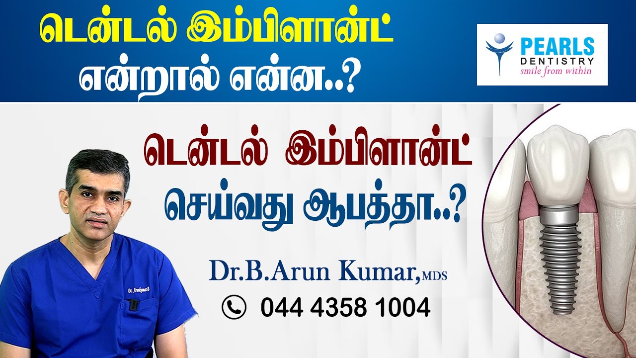 டென்டல் இம்பிளான்ட் என்றால் என்ன? டென்டல் இம்பிளான்ட் செய்வது ஆபத்தா? PearlsDentistry-Dr.Arunkumar