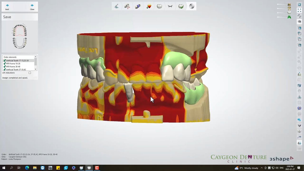 Cast Partial Upper and Lower Digital Designs