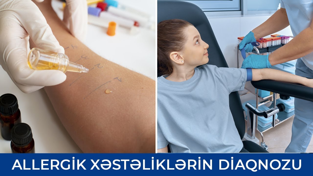 Allergik Xəstəliklərin Diaqnozu - Şəhla Mustafayeva ( Pediatr-allerqoloq )