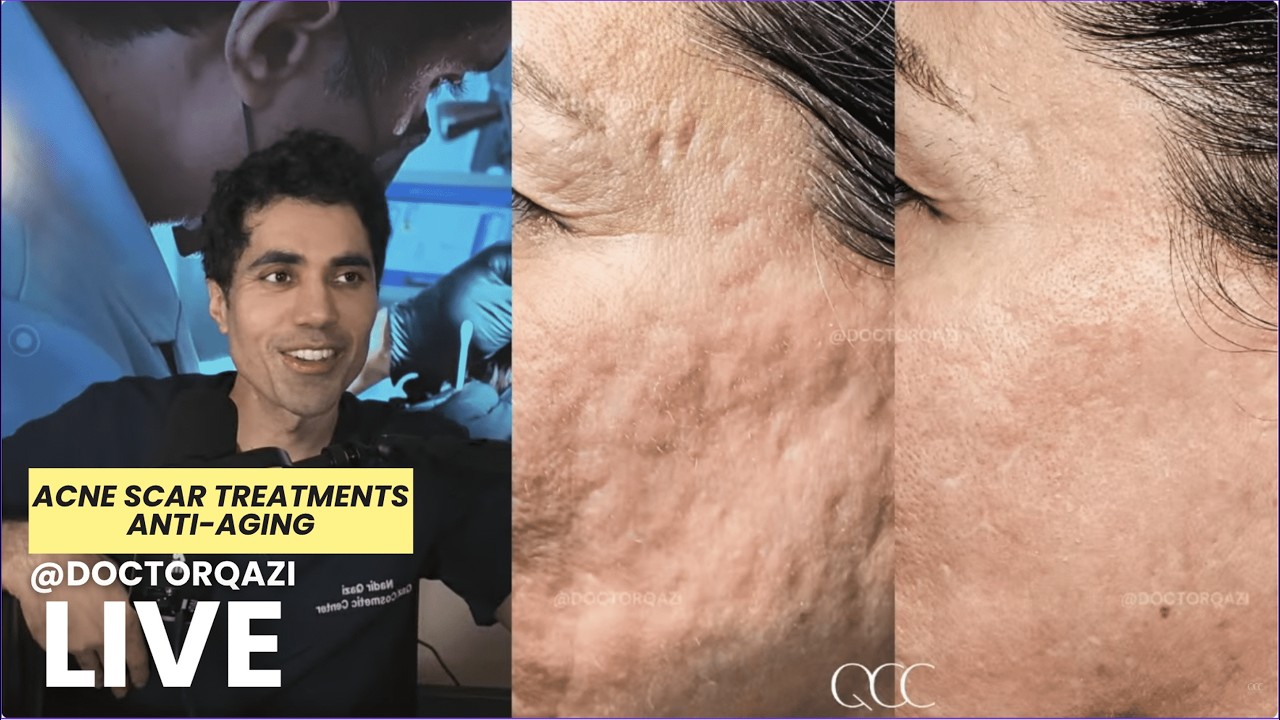 Dr. Qazi Discussing Acne Scar Treatments and More | Unsponsored LIVE | 2.24.2026