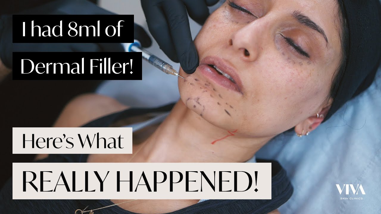 Full Face Dermal Filler! 😱 Here's what REALLY happened! (2021)