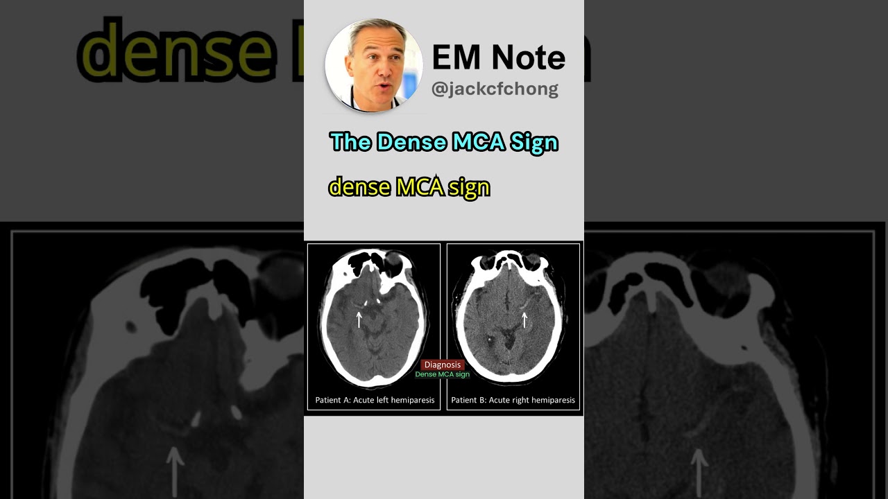 Dense MCA Sign