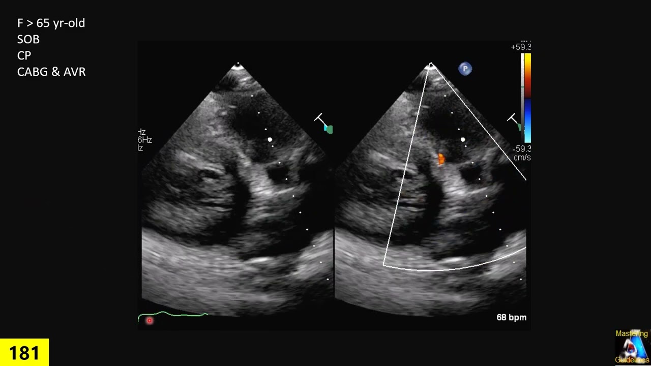 case study 18: coronary vs VSD
