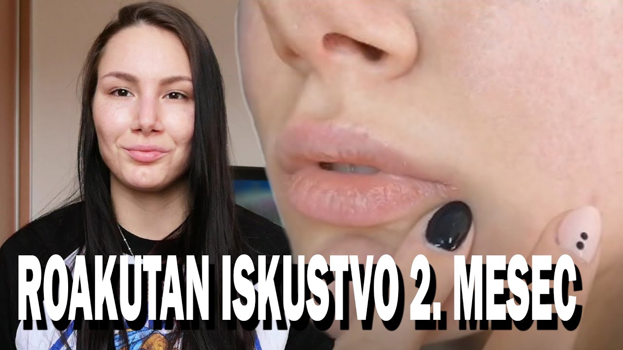 ROAKUTAN ISKUSTVO - Drugi mesec