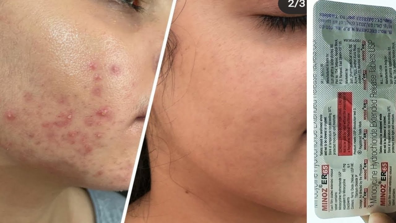 Minoz Er 65 Tablet | Minocycline Hydrochloride 65 Tablets | Minoz Er 65 Tablet पिंपल का लास्ट ईलाज