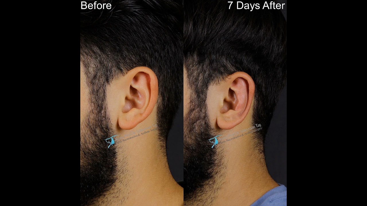 Otoplasty Surgery | Before And 7 Days After
