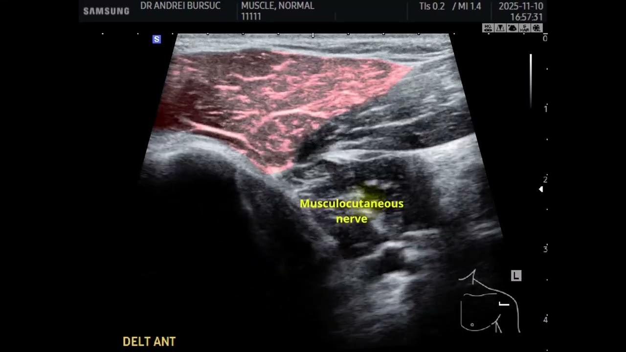 Anterior Deltoid Ultrasound - Deltoide antérieur échographie - Spasticité
