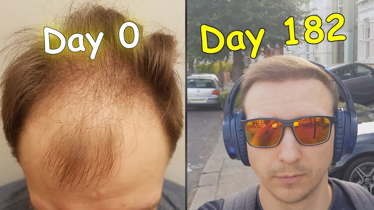 FUE Hair Transplant 6 months | 3500 grafts result
