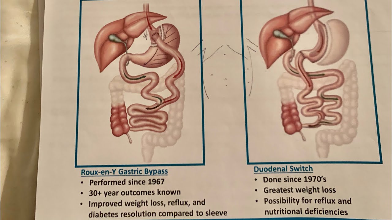 Revision VSG to RNY post op 1 day & Hiatal Hernia repair