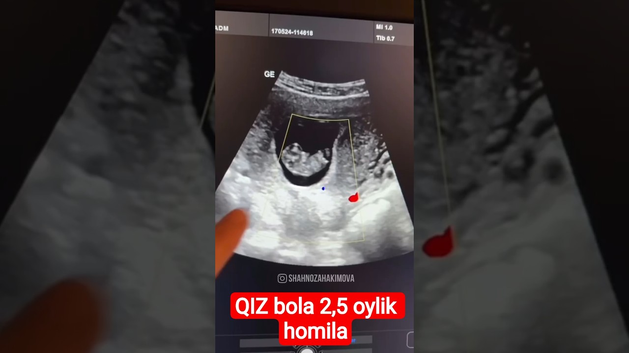 Qiz bola 2.5 oylik homilasi bor😱 #doctor #baby #shorts
