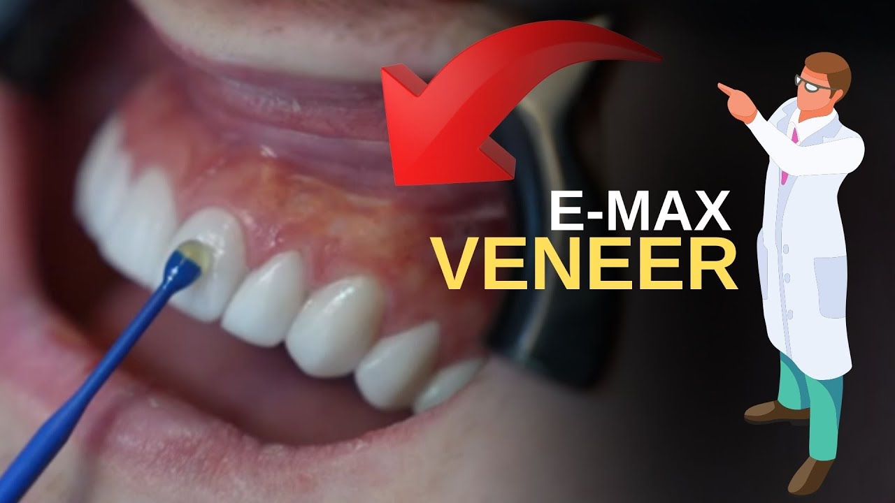 How to Emax Veneer | Dental Treatments in Turkey Antalya