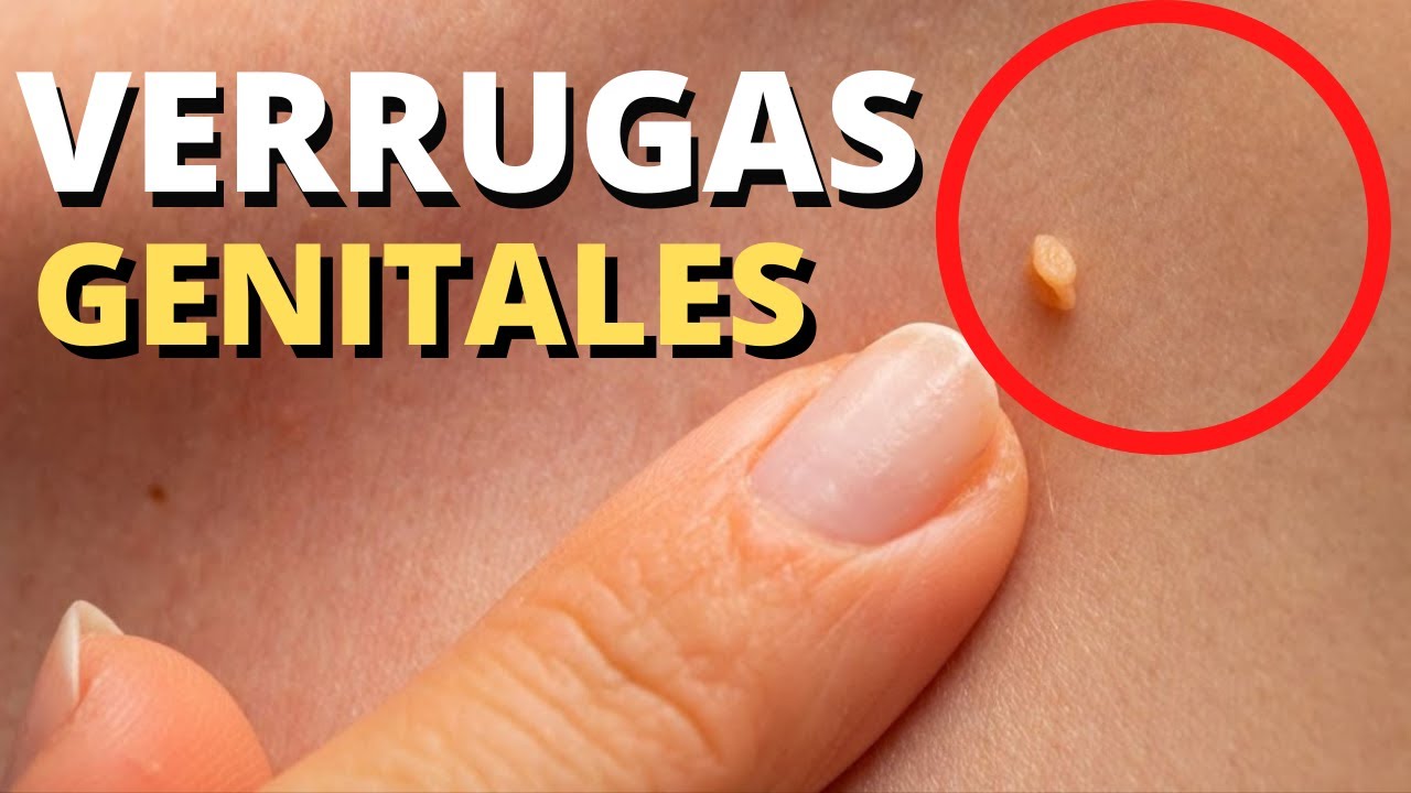 Verrugas genitales: diagn&oacute;stico, s&iacute;ntomas, tratamiento y prevenci&oacute;n (virus del papiloma humano)