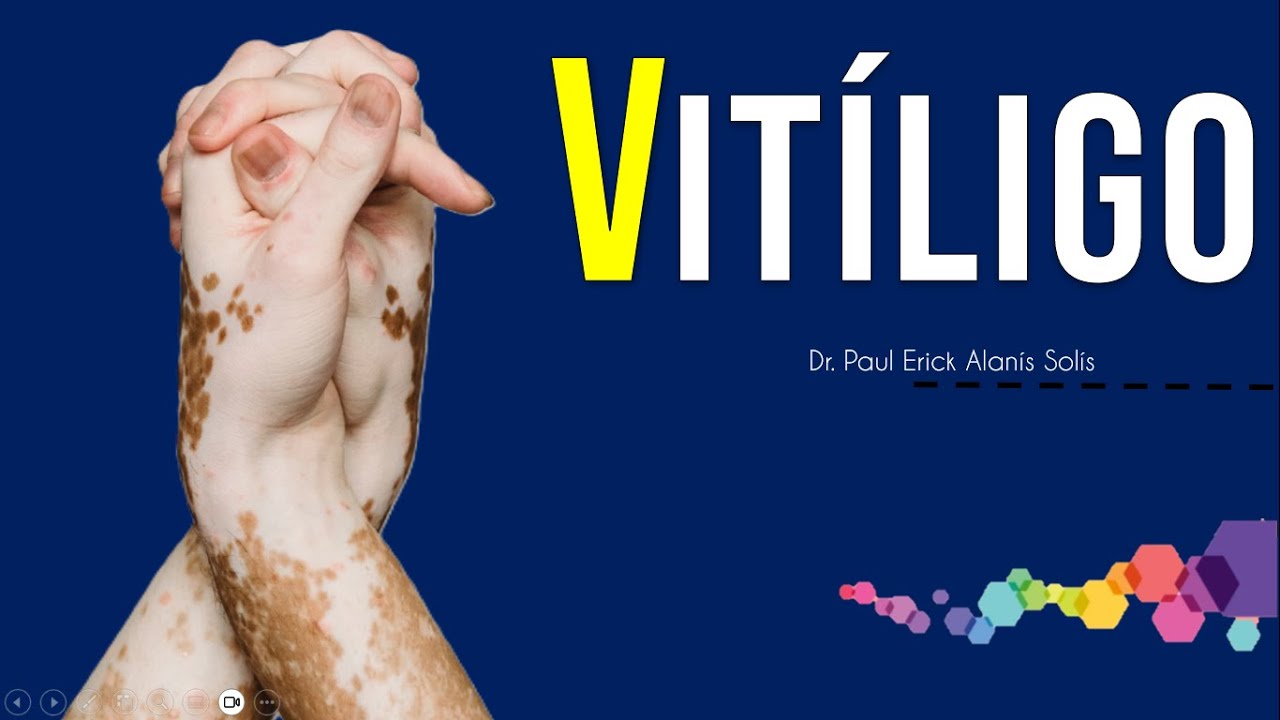 Vitíligo