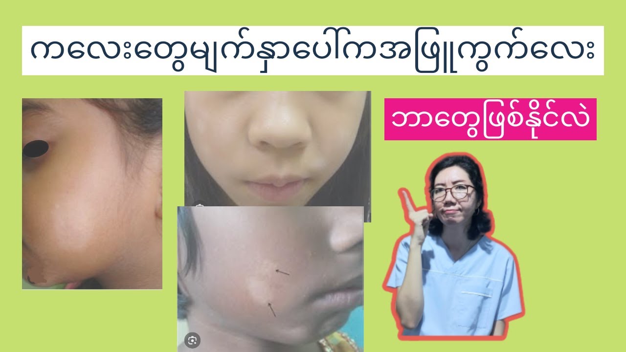 ကလေးမျက်နှာပေါ်ကအဖြူကွက်လေးတွေ