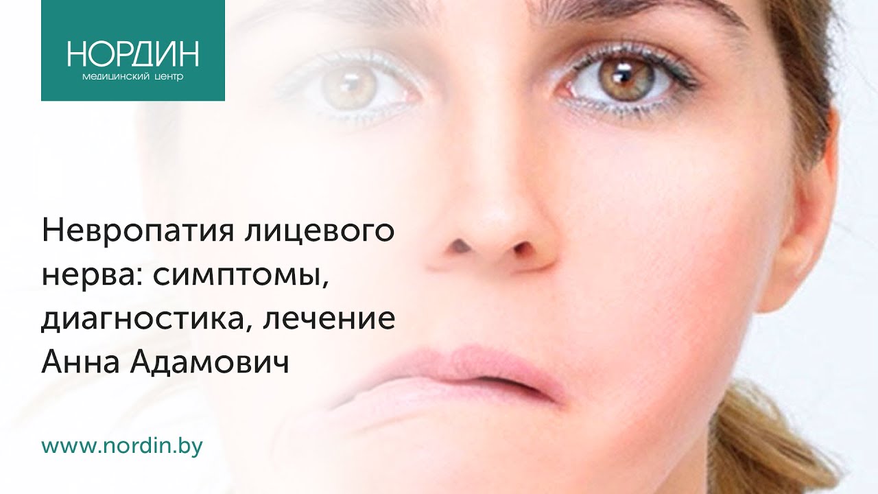 Невропатия лицевого нерва (паралич Белла): симптомы, диагностика, лечение