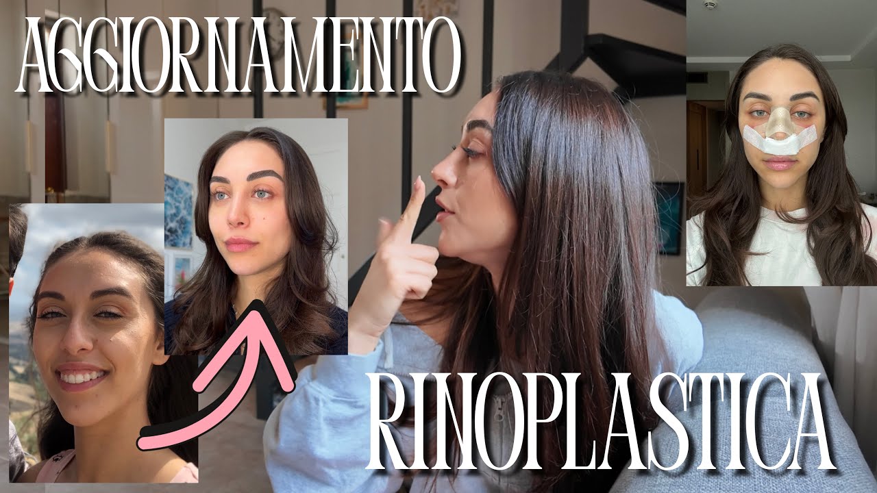 É GIÀ PASSATO UN ANNO: lo rifarei? ‼️ #rinoplastica 