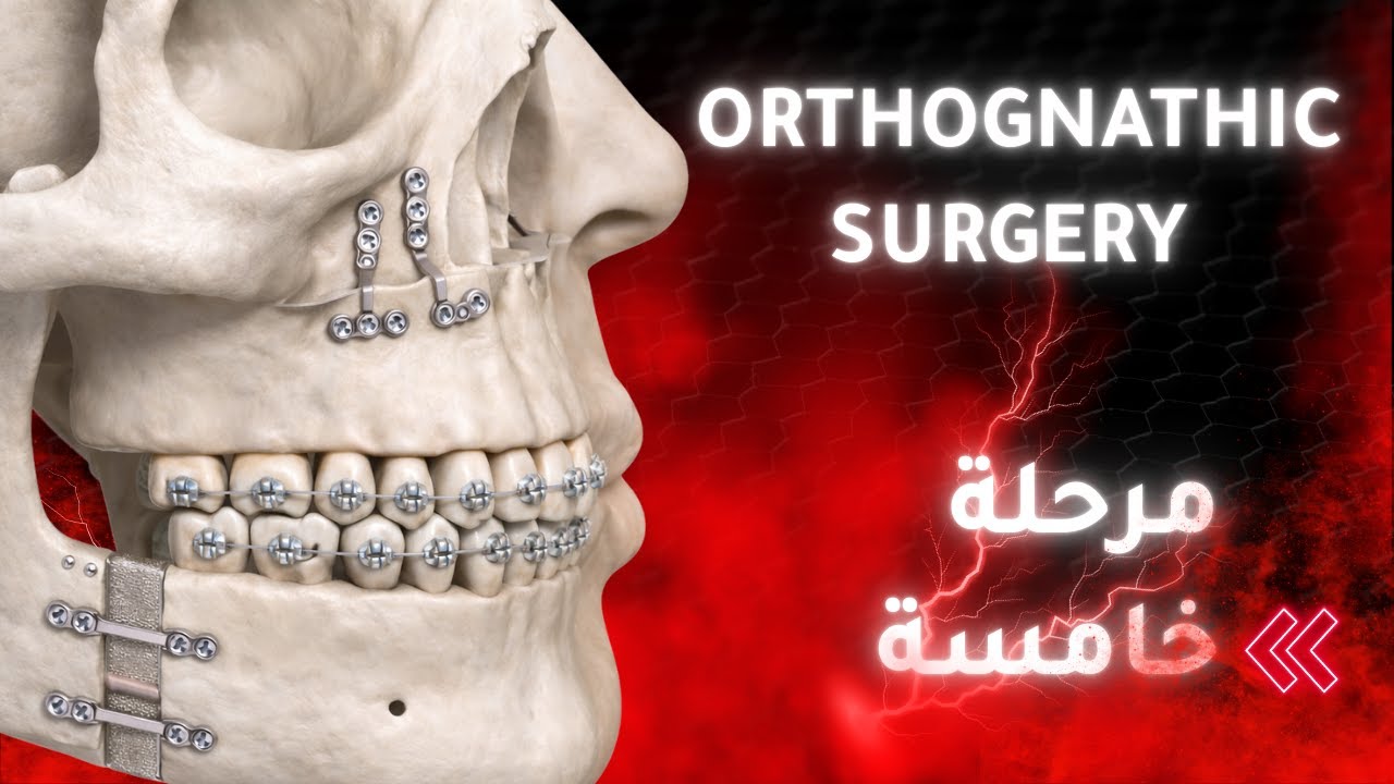 Orthognathic Surgery P.1 - شرح جراحة الفم طب اسنان مرحلة خامسة وزاري