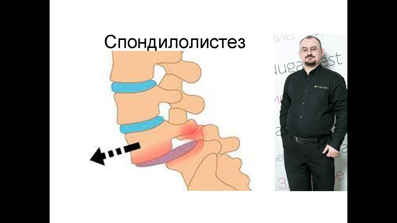Спондилолистез – что это такое и как его лечить