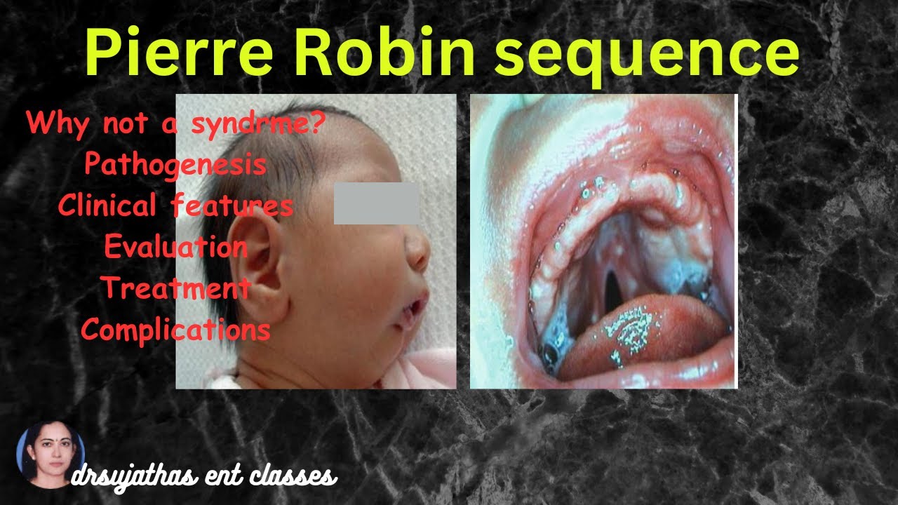 263.Pierre robin sequence. Syndromes in ENT #surgeryeducation