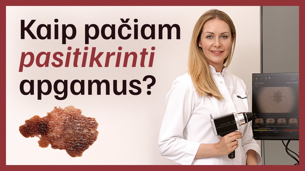 Kaip pačiam pasitikrinti apgamus? 🟤 🔎