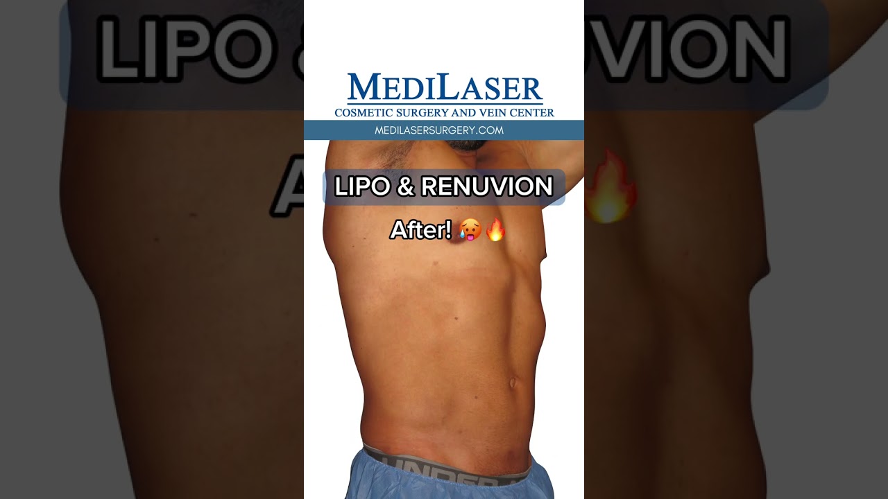 MALE LIPO + RENUVION