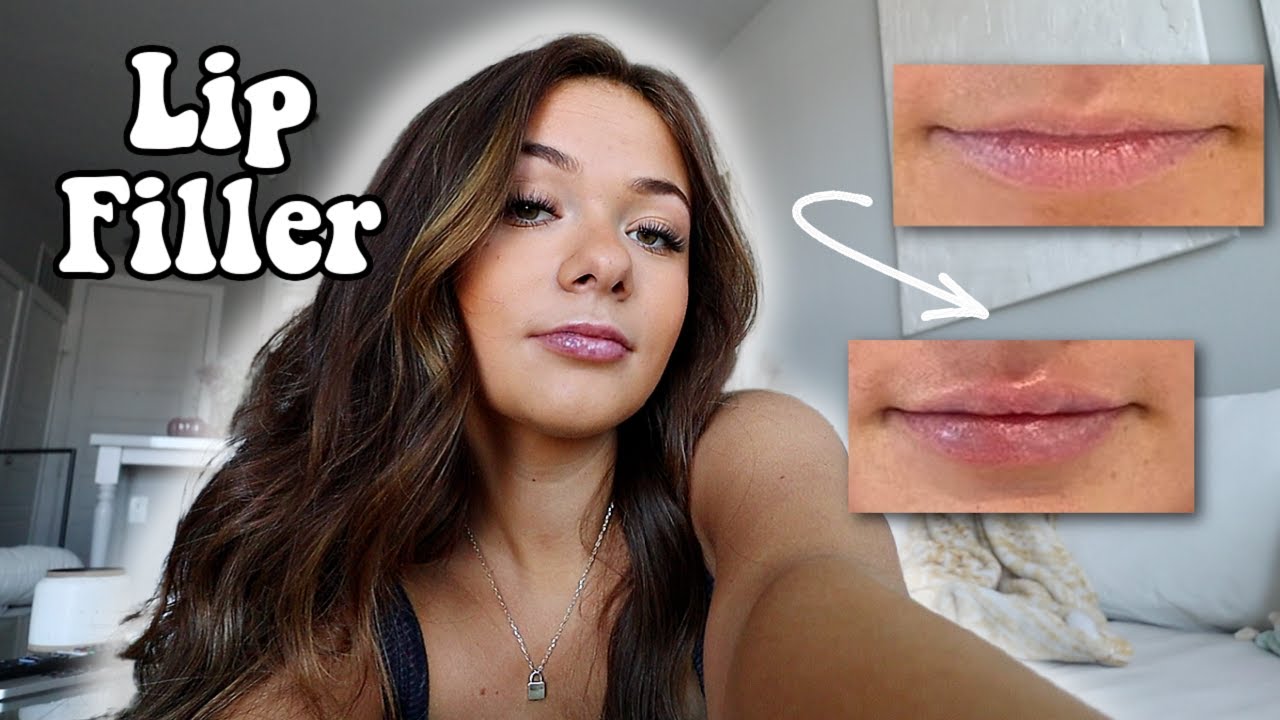 GETTING LIP FILLER FOR THE FIRST TIME | before & after, my experience
