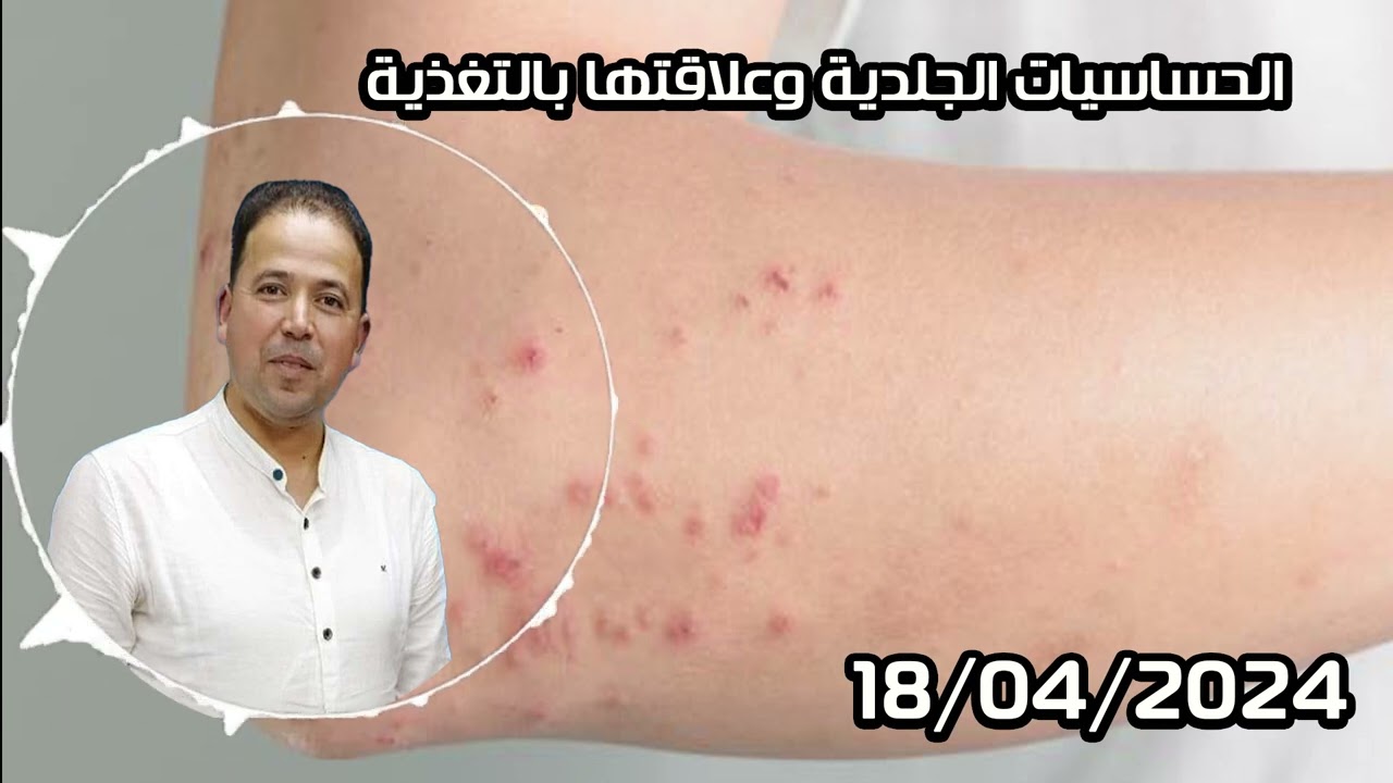 الحساسيات الجلدية وعلاقتها بالتغذية الدكتور محمد احليمي